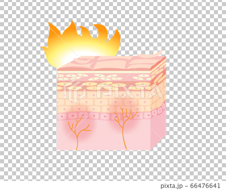 皮膚發炎的插圖 皮膚發炎的插圖 66476641