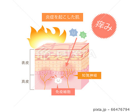 皮膚炎を起こして痒い皮膚の図解のイラスト素材 皮膚炎を起こして痒い皮膚の図解のイラスト素材