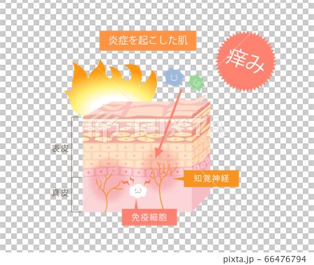 Illustration of itchy skin with dermatitis - Stock Illustration ...