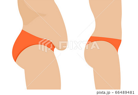 Female belly fat loss plastic surgery. Abdomen fatty girl abs lose before and after cellulite 66489481