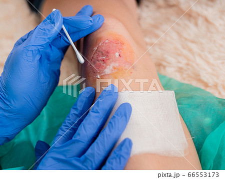 Close-up, treatment of an abrasion on the knee of a teenage girl by a doctor. Close-up, treatment of an abrasion on the knee of a teenage girl by a doctor. 66553173