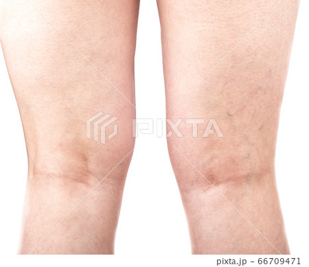 Female legs with varicose veins on the back of the legs. Female legs with varicose veins on the back of the legs. 66709471
