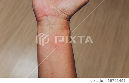 Red blisters on the hand and dermatitis, itching from allergies, skin diseases or insects, poisonous animals bite. Red blisters on the hand and dermatitis, itching from allergies, skin diseases or insects, poisonous animals bite. 66741461