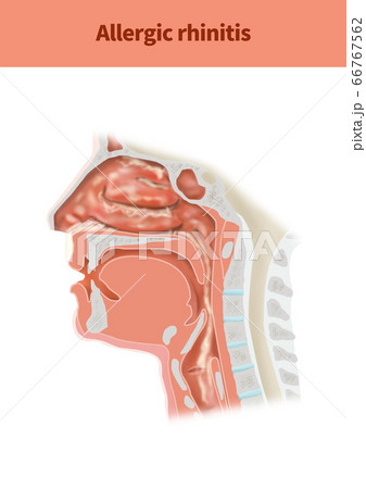 解剖学 疾患 鼻炎のイラスト素材
