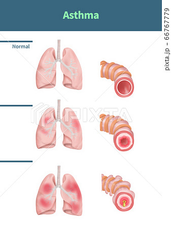 医学 喘息 呼吸器 66767779