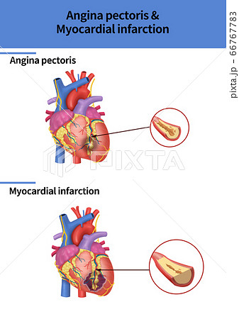 医学 狭心症 胸痛のイラスト素材