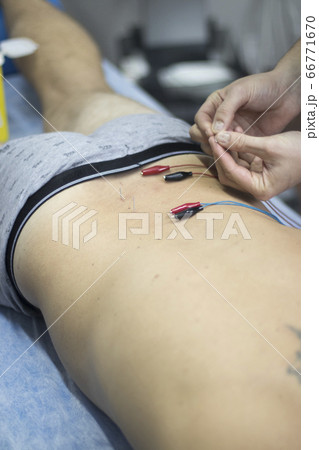 EPI dry needling physiotherapy EPI dry needling physiotherapy 66771670