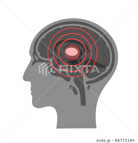 Pain Brain Illustration Pain Brain Illustration 66773184