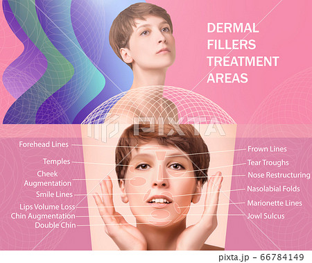 Treatment areas for anti-wrinkle injection. 66784149