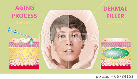 Cosmetic filler or dermal fillers Cosmetic filler or dermal fillers 66784153