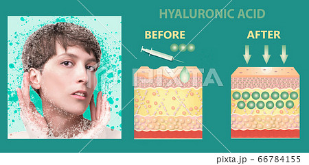 Hyaluronic acid. skin-care products. skin rejuvenation Hyaluronic acid. skin-care products. skin rejuvenation 66784155