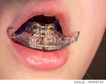 Palatal expander for the maxilla. Lingual braces Palatal expander for the maxilla. Lingual braces 66808728
