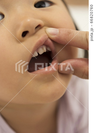 子供の歯　癒合歯 66820760