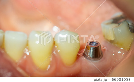 Profile view of implant in the lower part 66901053