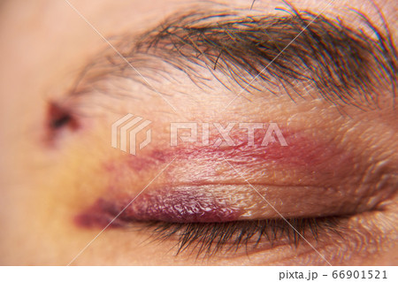 close view of a bruise near the eye, the face of a 66901521