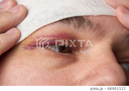 close view of a bruise near the eye, the face of a 66901522