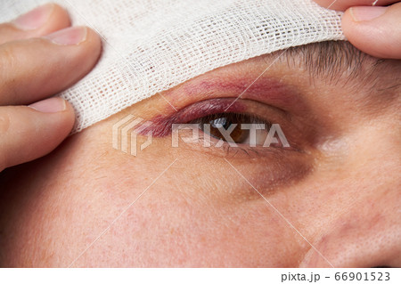 close view of a bruise near the eye, the face of a 66901523