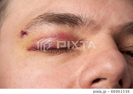 close view of a bruise near the eye, the face of a 66901536