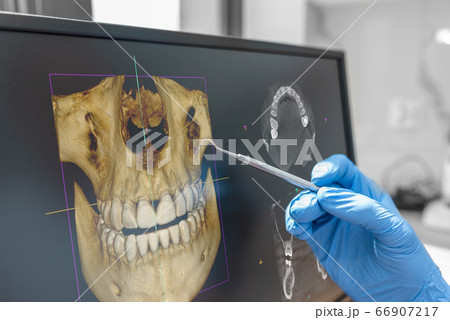 Dental consultation with 3D tomography image Dental consultation with 3D tomography image 66907217