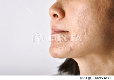 Skin problem with acne diseases, Close up of asian woman face with whitehead pimples 66953841