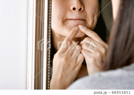 Acne pus, Close up photo of acne prone skin, Woman looking at mirror and hand squeezing her acne Acne pus, Close up photo of acne prone skin, Woman looking at mirror and hand squeezing her acne 66953851