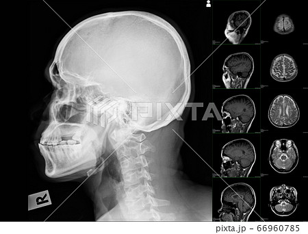 scan brain skull 66960785