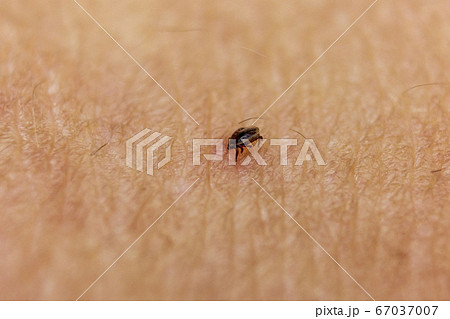 Tick bitten in human skin 7 67037007