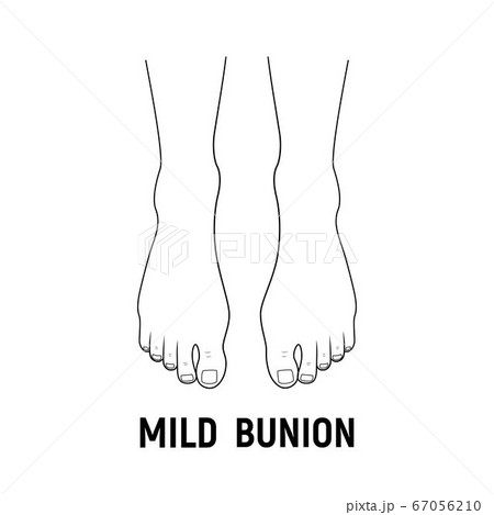 Hallux valgus, mild bunion. 67056210