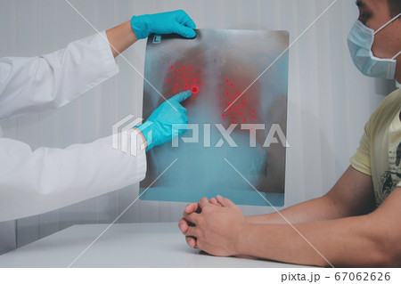 Doctor explain Coronavirus Disease 2019 or Covid-19 displayed on x-ray film to patiant. 67062626