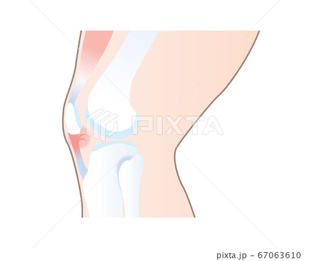 膝蓋靭帯が損傷したイラストのイラスト素材