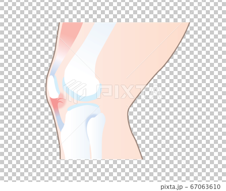 膝蓋靭帯が損傷したイラスト 67063610