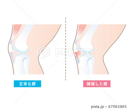 膝蓋靭帯を損傷した膝と正常な膝の図解イラストのイラスト素材
