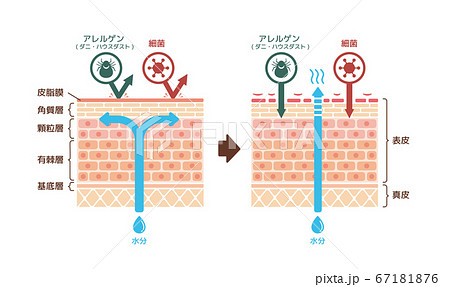 健康な皮膚とアトピー性皮膚炎 比較断面図イラストのイラスト素材
