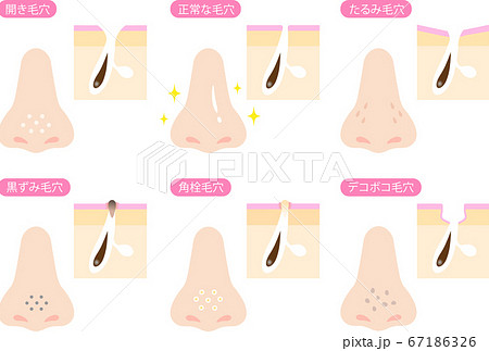鼻と毛穴 肌の断面図 セット 鼻と毛穴 肌の断面図 セット 67186326