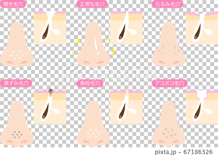 鼻と毛穴 肌の断面図 セット 鼻と毛穴 肌の断面図 セット 67186326