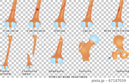 Types of Bone Fractures Types of Bone Fractures 67187039