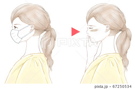 マスクをした横顔の女性とマスクシミ 摩擦と肝斑のイラスト素材 67250534 Pixta