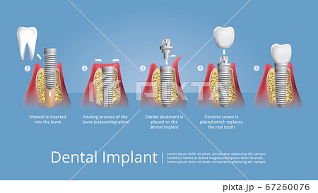 Human teeth and Dental implant Vector Illustration 67260076