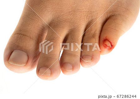 足の小指の怪我で出血の写真素材