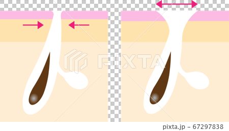 開き毛穴　ビフォアアフター 67297838