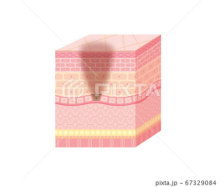 シミのある皮膚の断面図 67329084