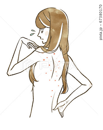 背中ニキビに悩んでいる女性 背中ニキビに悩んでいる女性 67380170