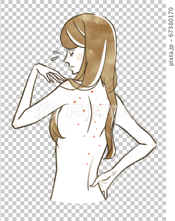 背中ニキビに悩んでいる女性 背中ニキビに悩んでいる女性 67380170