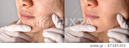 Skin problems and acne scar, Before and after acne facial care treatment, Beauty concept Skin problems and acne scar, Before and after acne facial care treatment, Beauty concept 67385303
