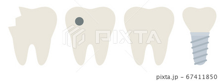 A set of four teeth, healthy and requiring treatment vector illustration in a flat design 67411850
