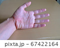 手洗い　手荒れ 67422164