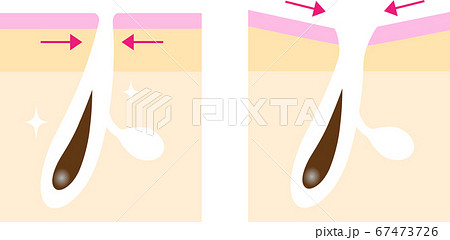 たるみ毛穴　ビフォアアフター　肌の断面図 67473726