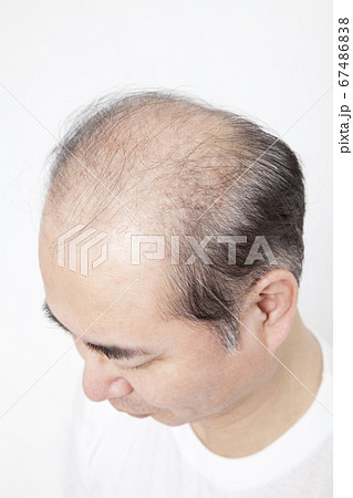 薄毛の男性 67486838