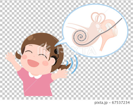 人工内耳をつけた女の子と蝸牛の電極のイラスト素材 [67537234] - PIXTA