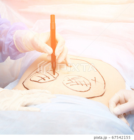liposuction operation. Doctor hands near belly liposuction operation. Doctor hands near belly 67542155